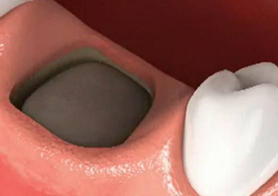 Bone Graft 