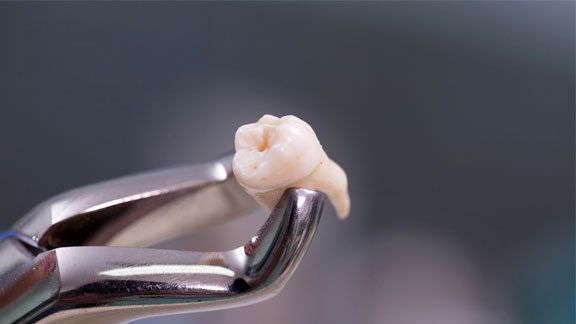 Bone Graft