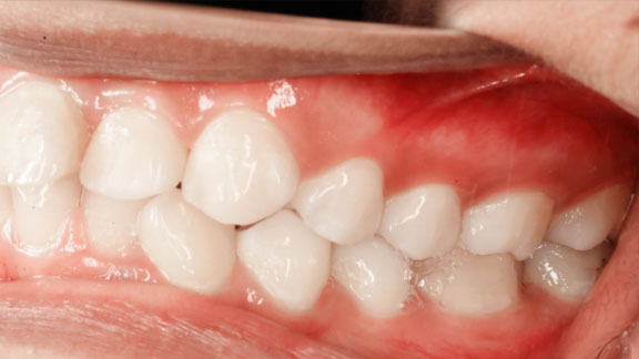 Bone Graft