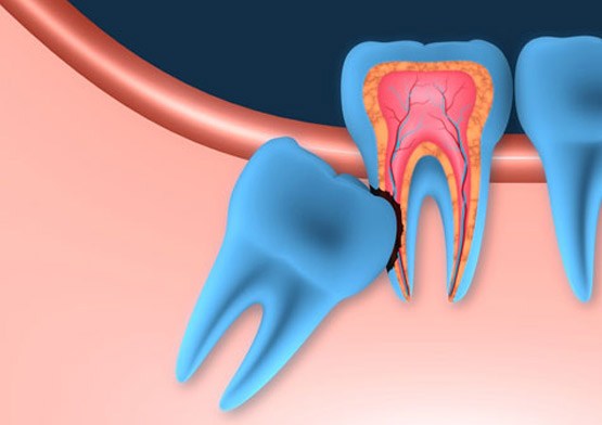 Tooth Extraction 