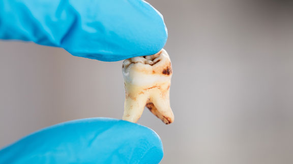 Gum Graft