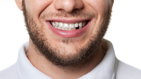 Gum Graft