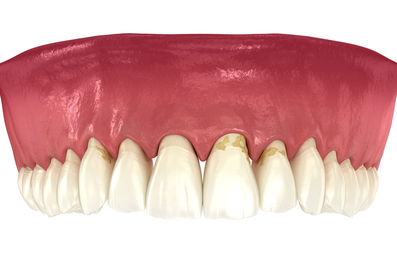 a full mouth model showing the effects of gingivitis.