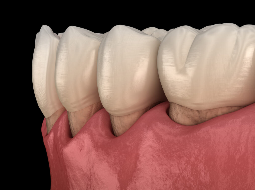 Gum recession process. Medically accurate 3D illustration.